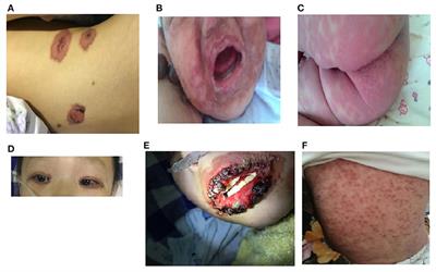 Case Report and Literature Review: Clinical Characteristics of 10 Children With Mycoplasma pneumoniae-Induced Rash and Mucositis